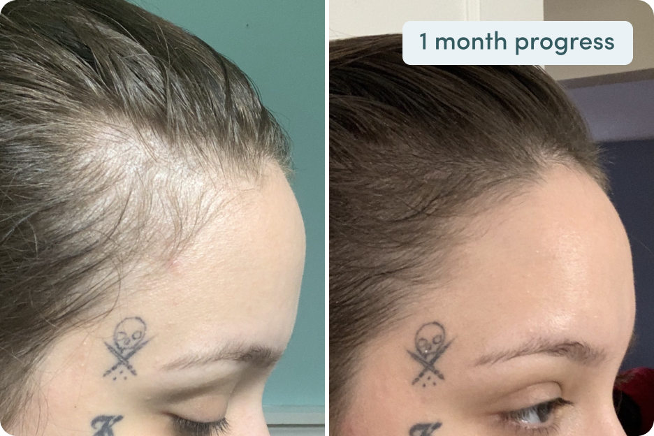 Can You Use Minoxidil While Breastfeeding? hers